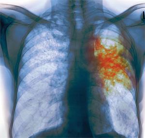 Симптомы заболевания туберкулезом легких