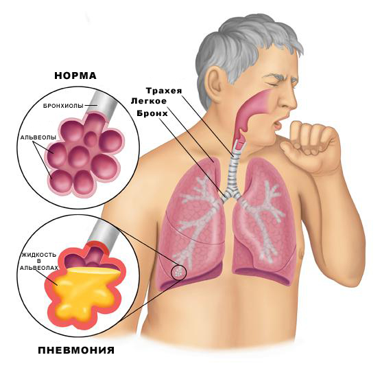 Признаки заболевания воспаления легких (пневмония)